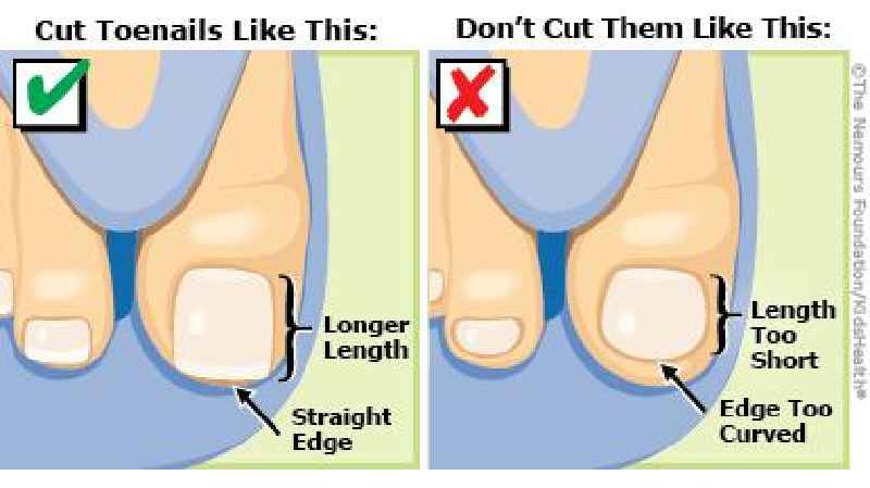 Should you stay off your feet after toenail removal
