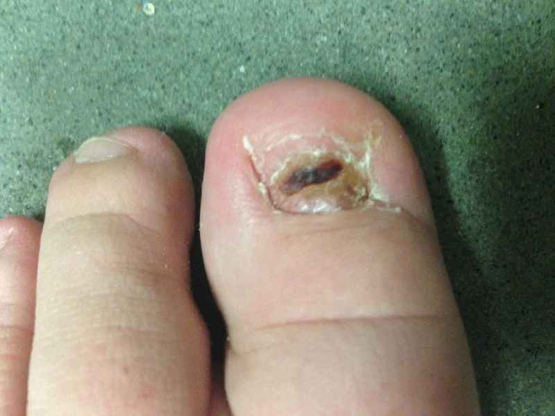 Should you use Neosporin after toenail removal
