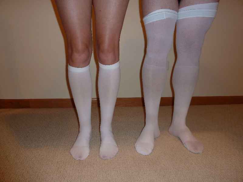 Should you wear compression stockings after sclerotherapy