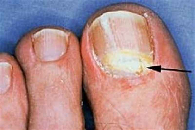 Should you wear socks to bed with toe fungus