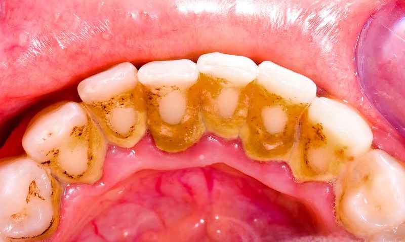 What are 5 oral health diseases