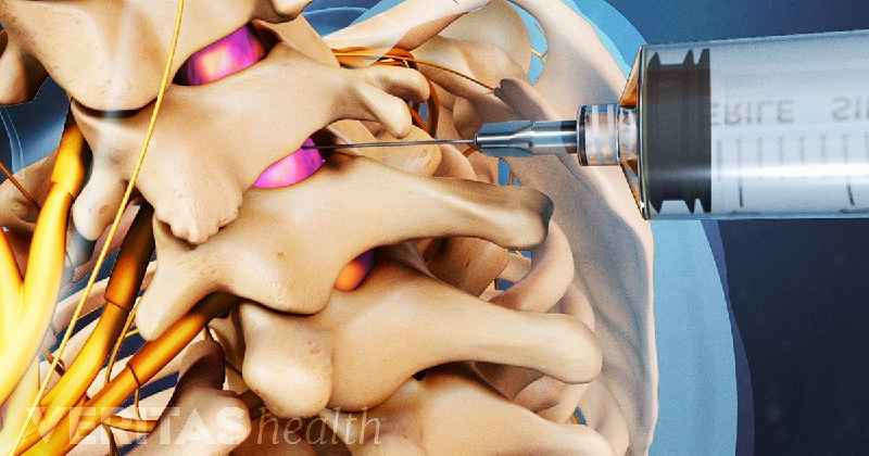 What are side effects of trigger point injections