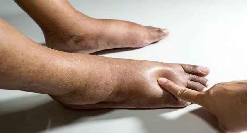 What are signs of diabetic feet