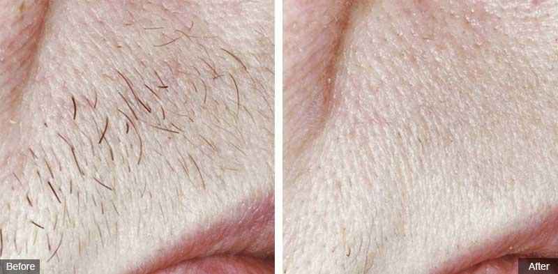 What are small medium and large areas for laser hair removal