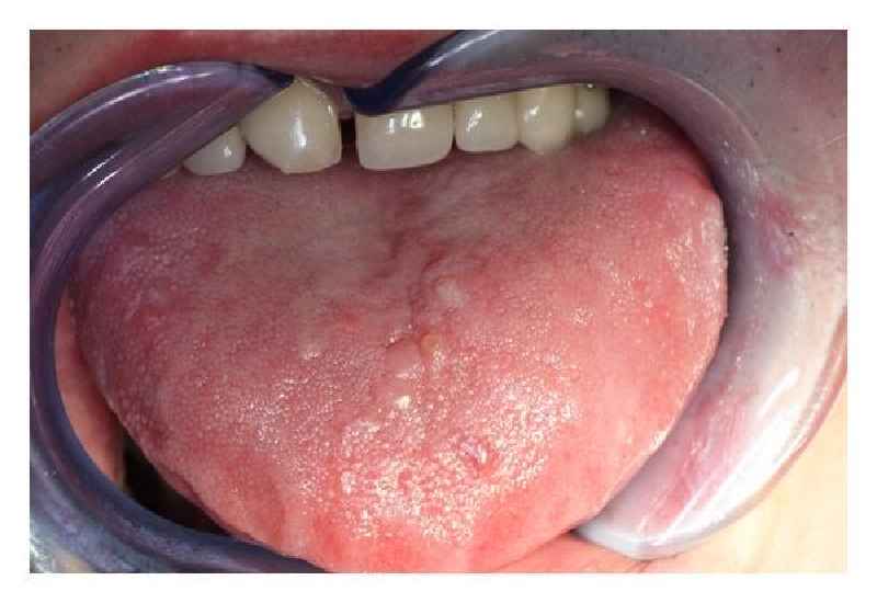 What are the 3 oral hygiene diseases