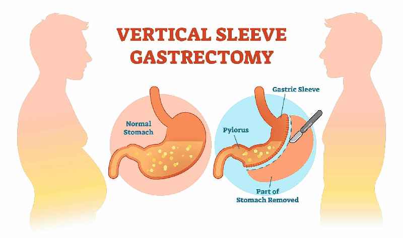 What are the cons of gastric sleeve