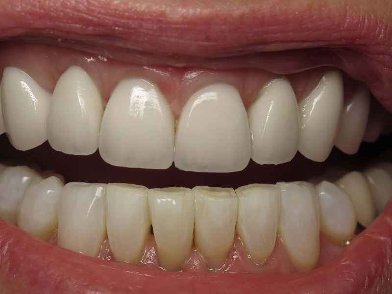 What are the disadvantages of veneers