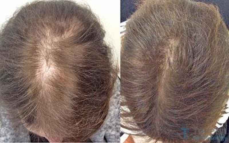 What are the most common types of abnormal hair loss