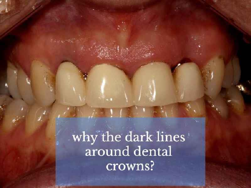 What are the most natural looking dentures