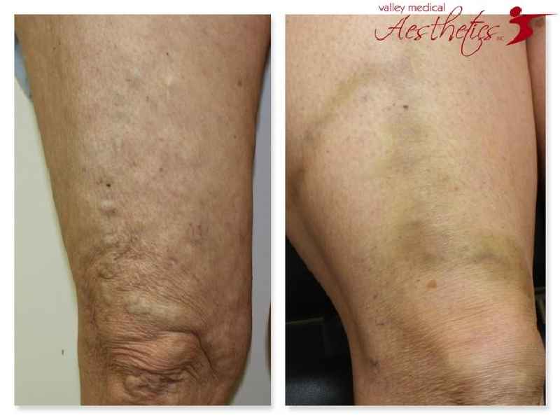 What are the side effects of laser treatment for varicose veins