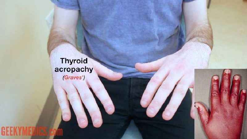 What are the symptoms of thyroid problems in females