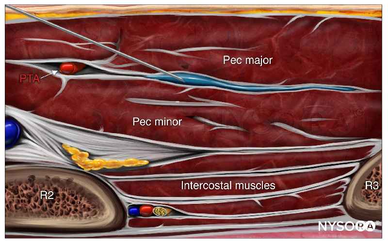 What are the types of nerve blocks