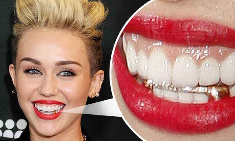 What are veneers for teeth