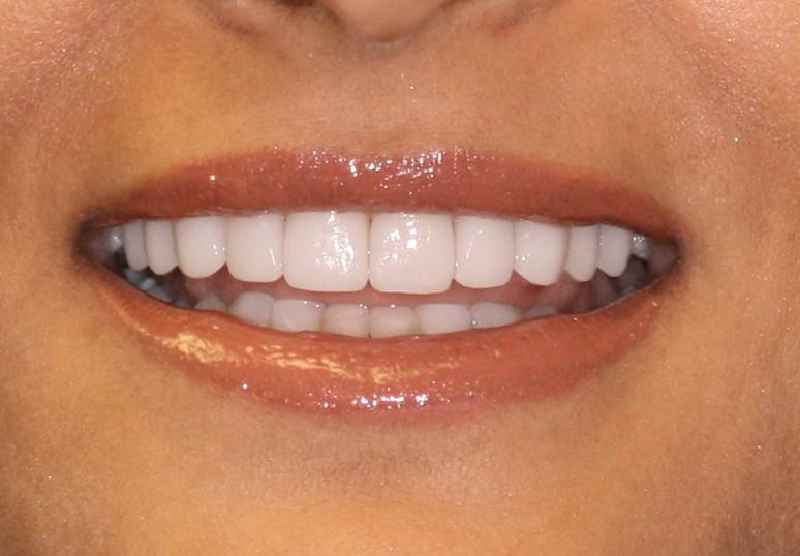 What are veneers teeth made of