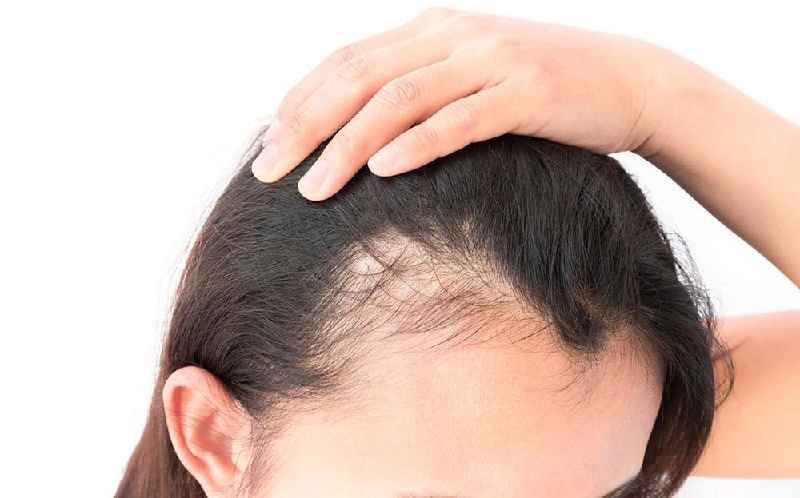 What autoimmune diseases cause hair thinning
