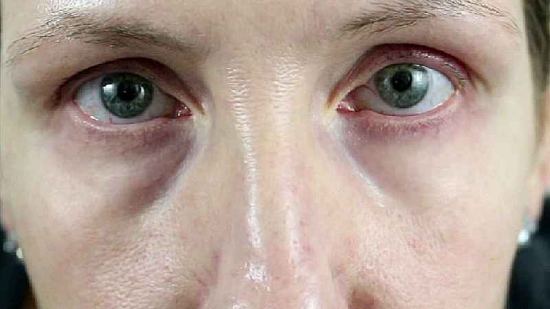 What can a dermatologist do for under-eye bags