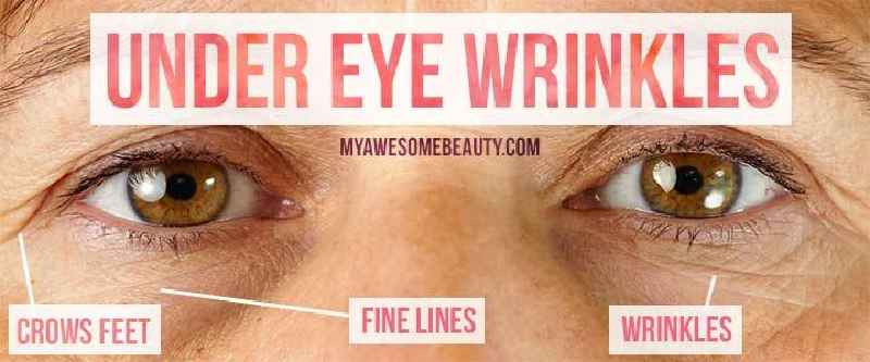What can a dermatologist do for under eye wrinkles