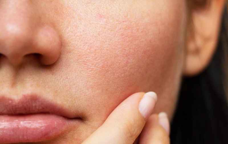 What can dermatologists do for large pores