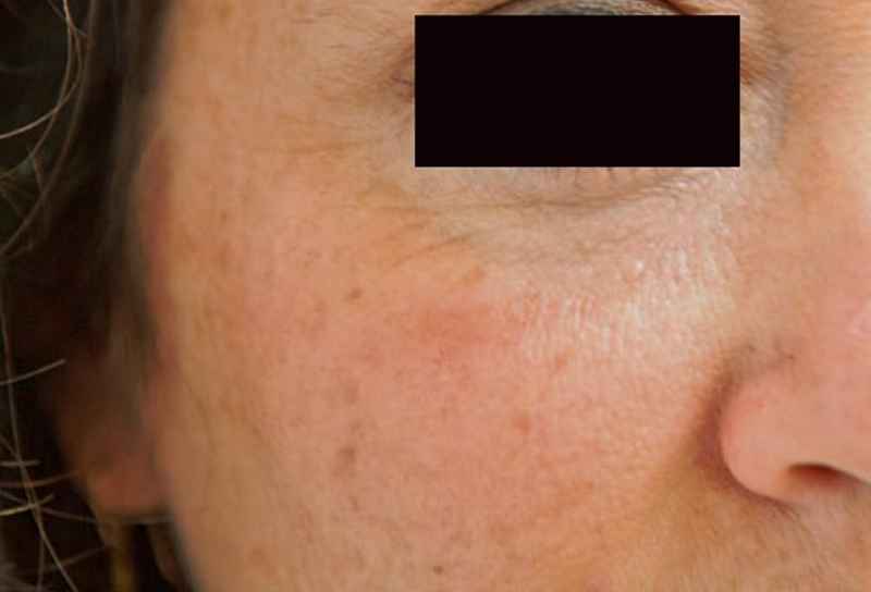 What can help facial dysmorphia