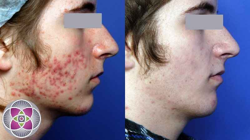 What can permanently remove acne scars