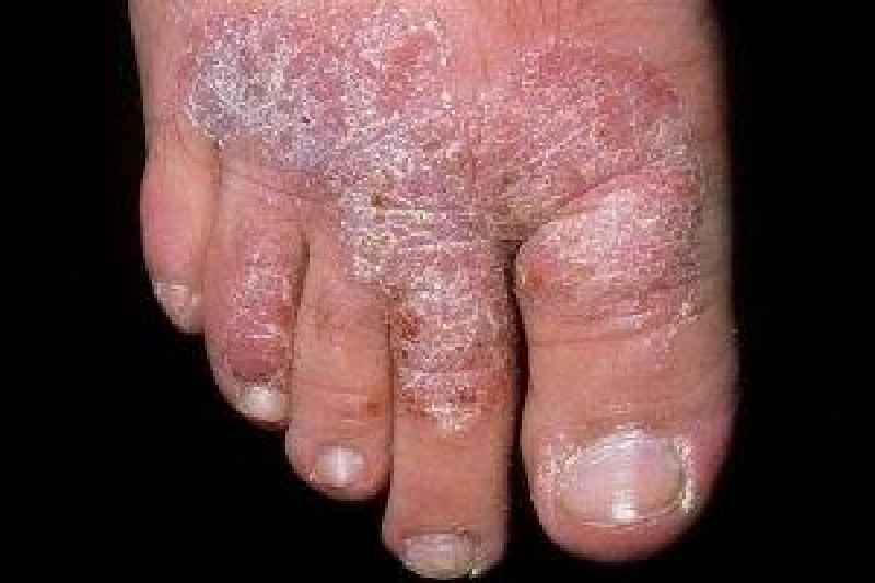 What can poor hygiene cause