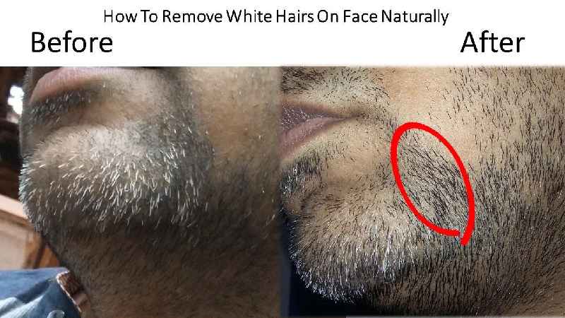 What causes a female to have facial hair
