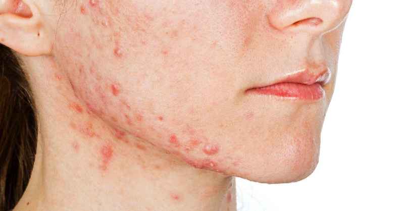 What causes acne on cheeks