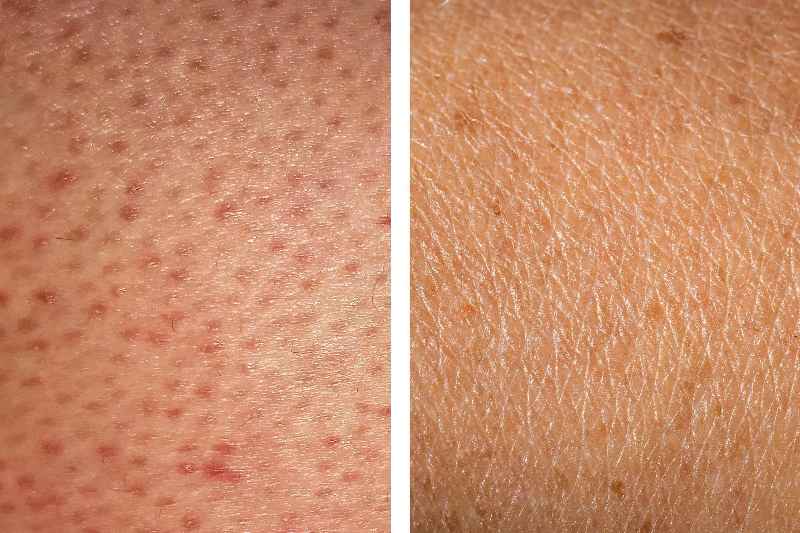 What causes cellulite on thighs
