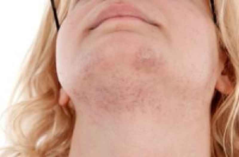 What causes chin hair in females