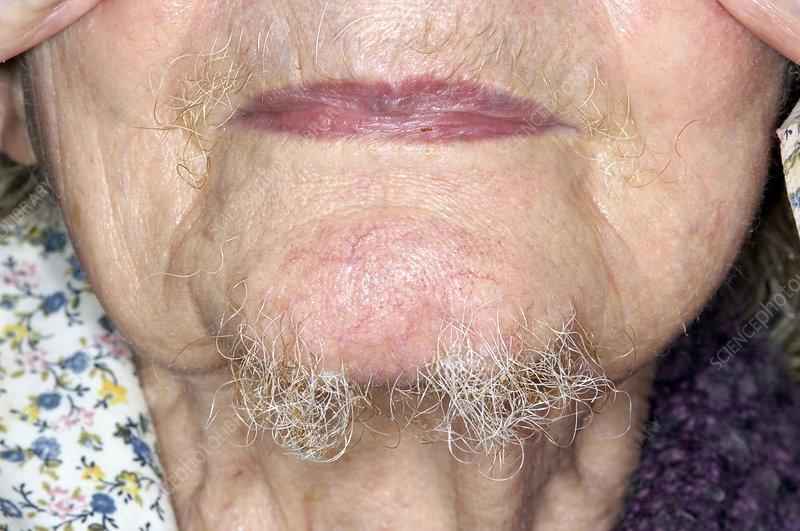 What causes chin hairs on females