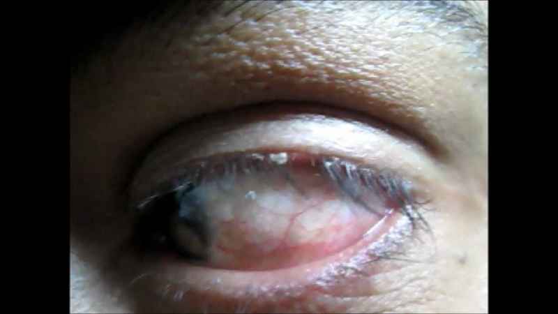What causes darkening around the eyes