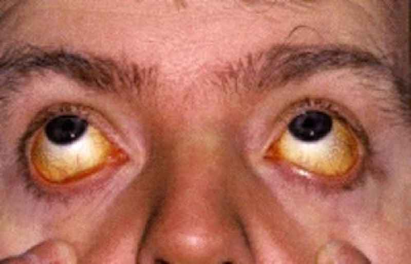What causes eyes to look old