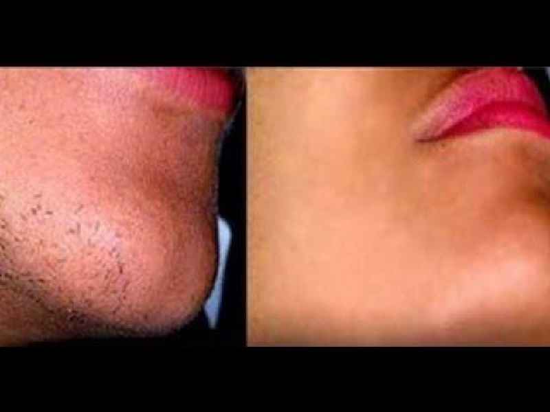 What causes facial hair for females