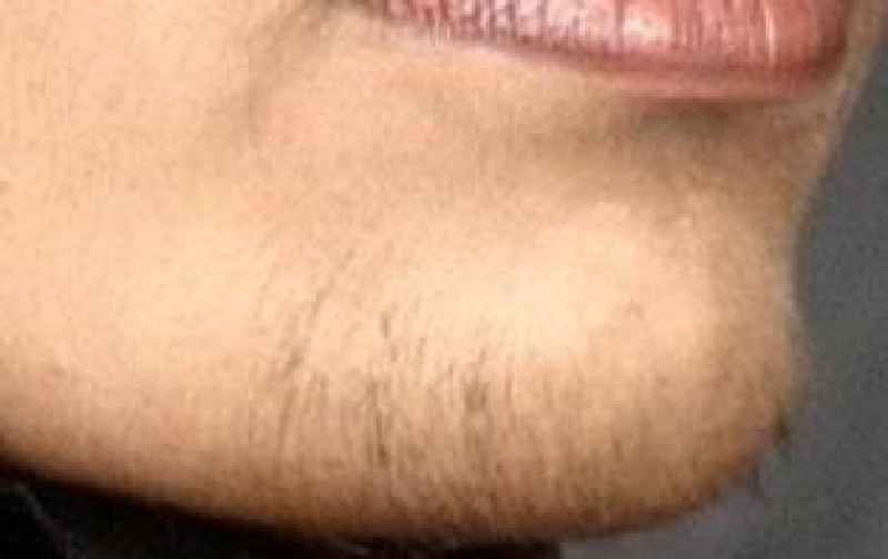 What causes female hair growth on chin