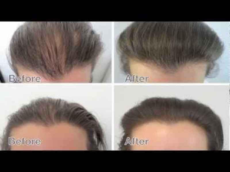 What causes female hair loss