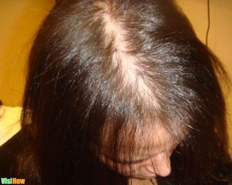 What causes female hair loss