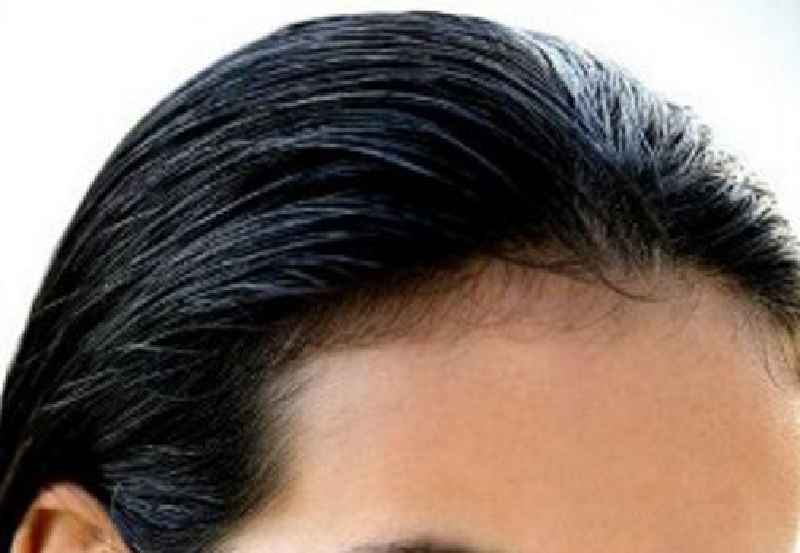 What causes female receding hairline