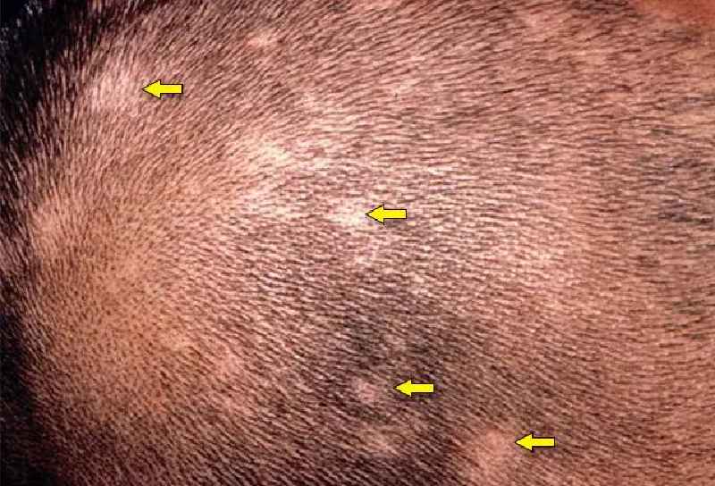 What causes hair loss in a 25 year old woman
