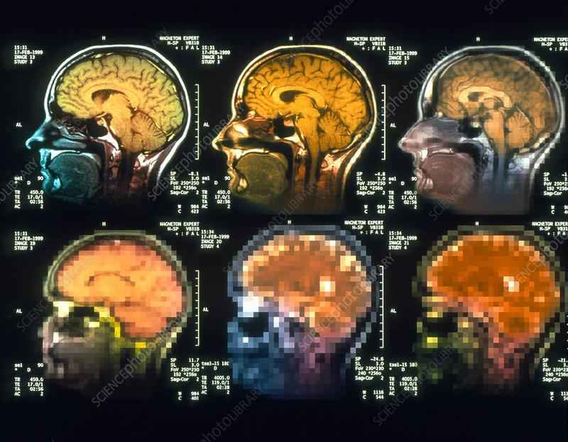 What causes mental illness in the brain