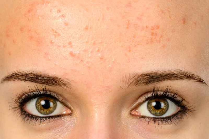 What causes open pores on the face