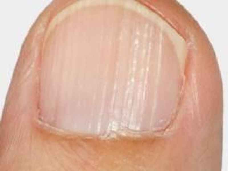 What causes vertical ridges in fingernails
