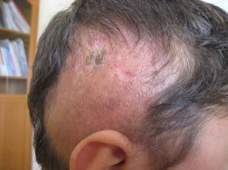 What chemicals destroy hair follicles