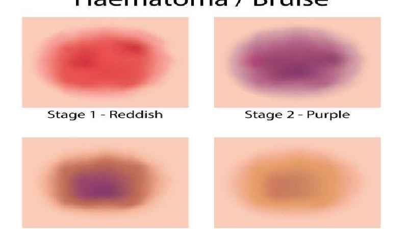 What color stages do bruises go through