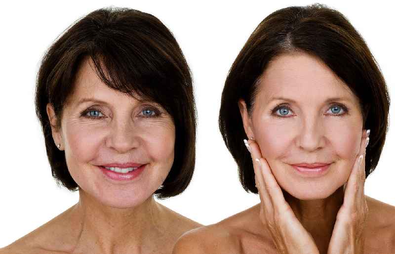 What cosmetic procedure makes you look younger