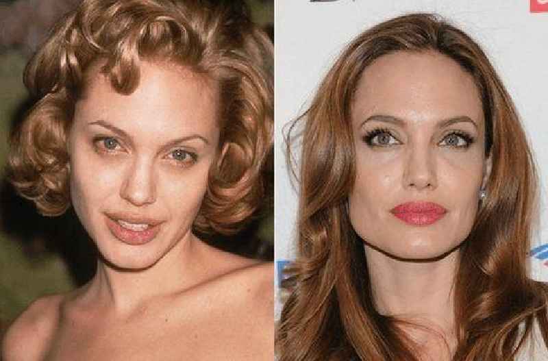 What cosmetic procedures do celebrities use