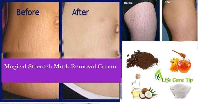 What cream removes burn marks