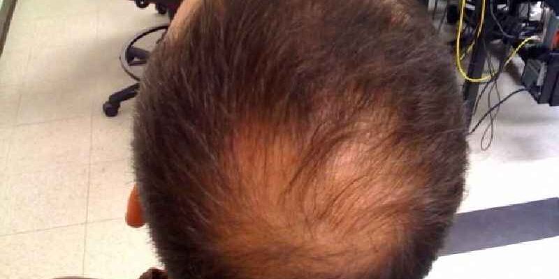 What deficiencies cause hairloss