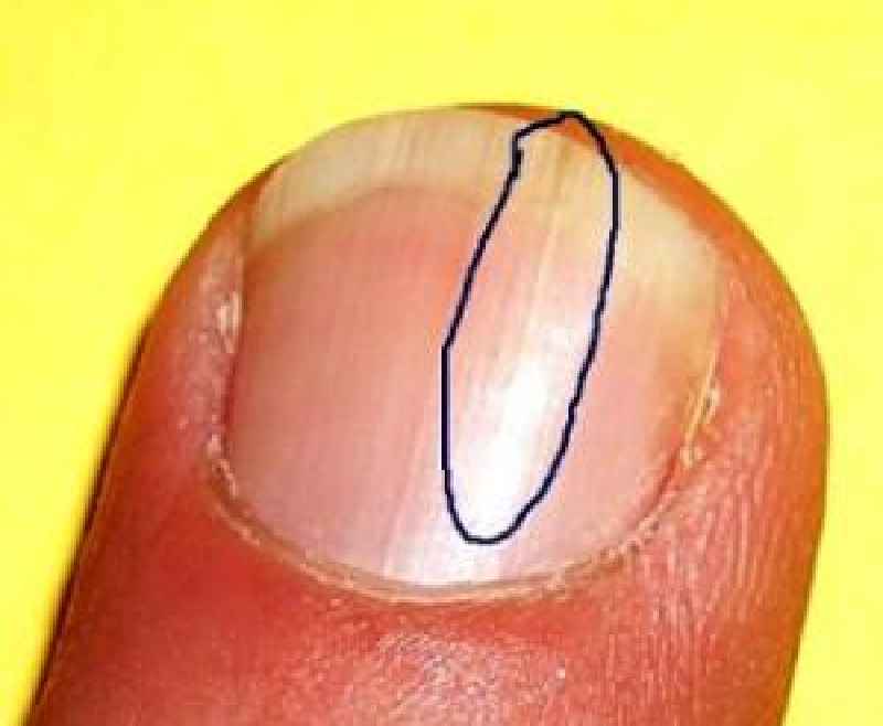 What deficiency causes weak nails