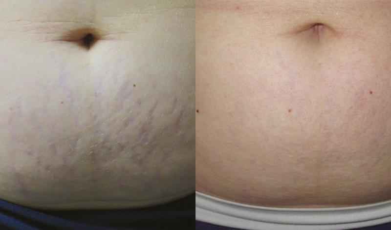 What dermatologist recommended stretch marks