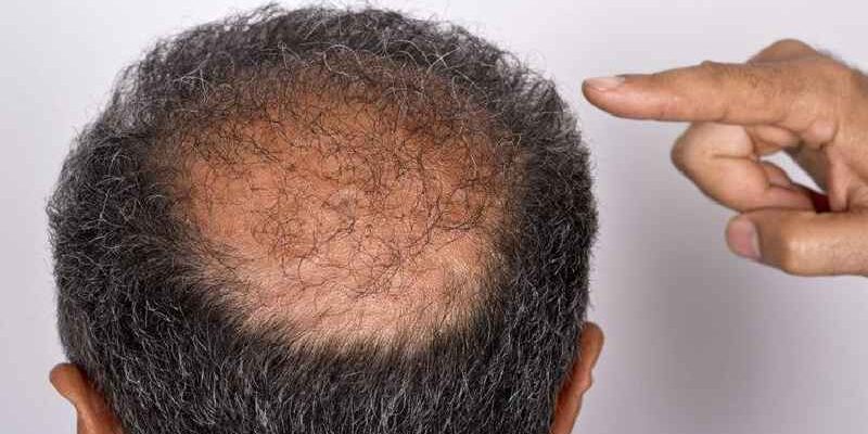 What diseases cause hair loss in females